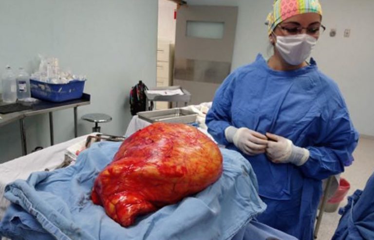 Extirpan tumor abdominal de 17 kilos a mujer en Durango