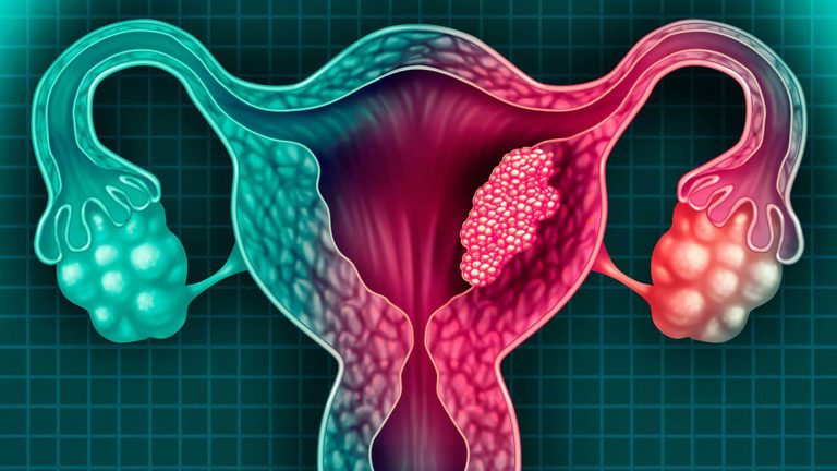 Aumenta el número de casos de mujeres jóvenes con cáncer cervicouterino