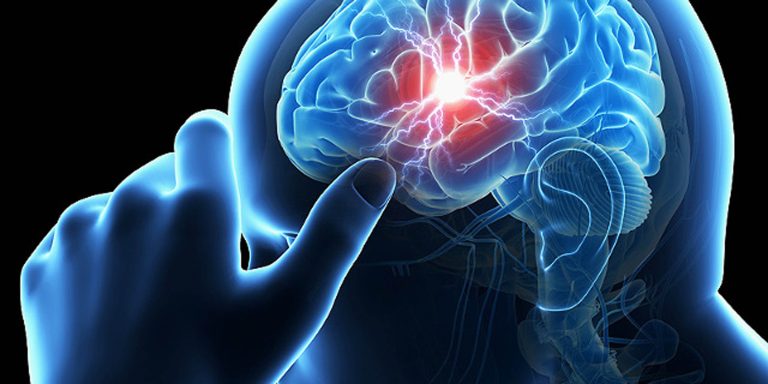 Identifican células que facilitan la recuperación por infarto cerebral