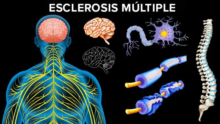 Esclerosis múltiple, primera causa de discapacidad de origen neurológico