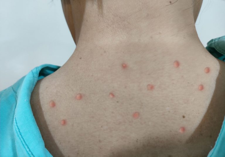 Estados Unidos reporta más de 3 mil 500 casos de viruela del mono