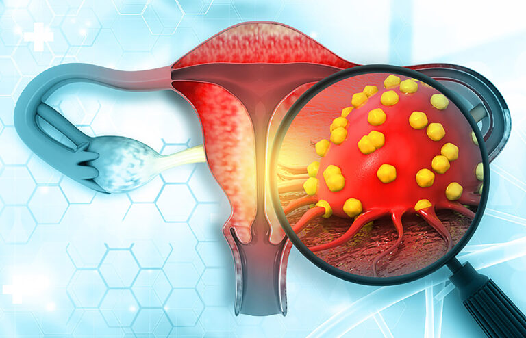 Se debe seguir estrategia de la OMS para reducir el cáncer cervicouterino