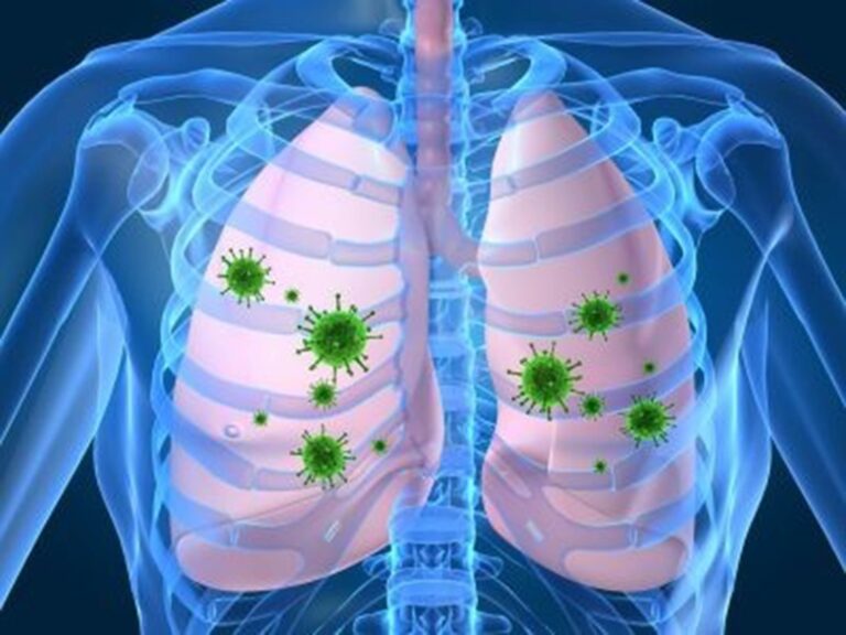 El mal manejo de la neumonía puede desencadenar resistencia bacteriana