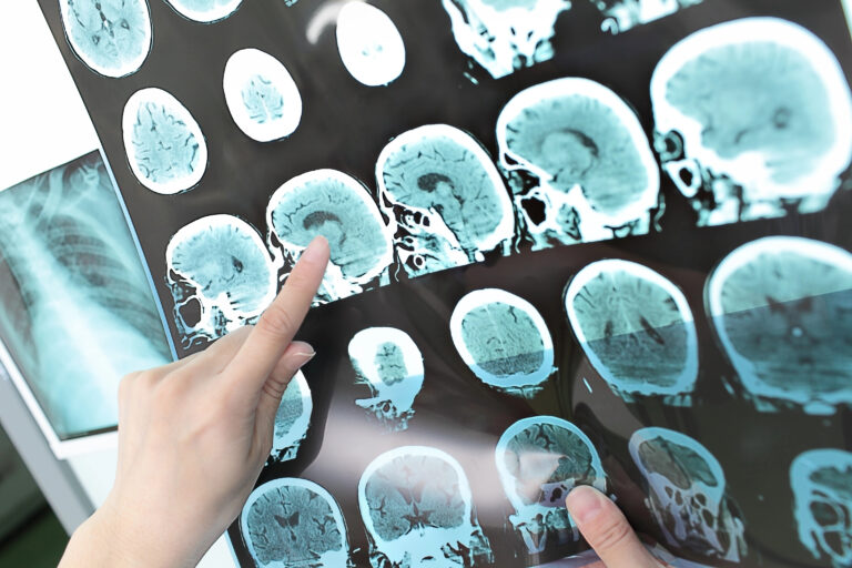 Un nuevo descubrimiento señala que es posible predecir el Alzheimer hasta 20 años antes a través de la grasa visceral
