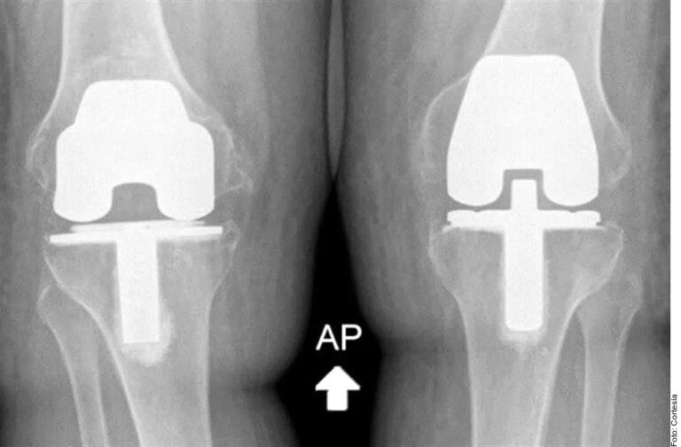 Avanzan problemas articulares en población joven