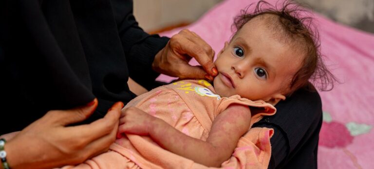 Yemen: Uno de cada dos niños está gravemente desnutrido tras 10 años de guerra