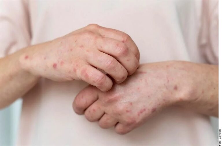 Alerta Secretaría de Salud a viajeros por sarampión en EU y Canadá