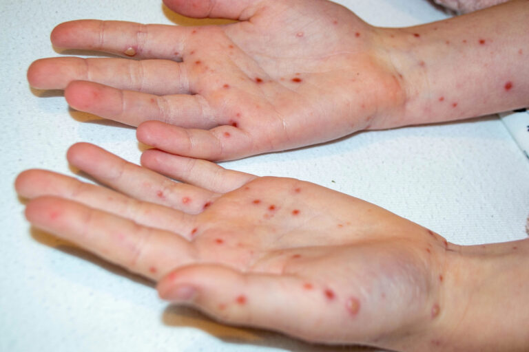 Reporta Chihuahua primera muerte por sarampión