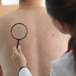 Oncologist holds magnifying glass in hand and examines pigmented nevi on patient’s back in clinic