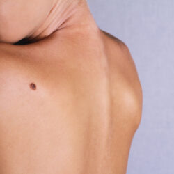 Checking,Benign,Moles,:,Young,Woman,Looking,With,Birthmark,On