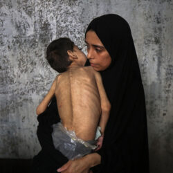 MIDEAST-GAZA CITY-CHILDREN-MALNUTRITION