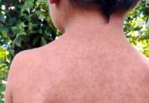 Persiste brote de sarampión en México.- OPS