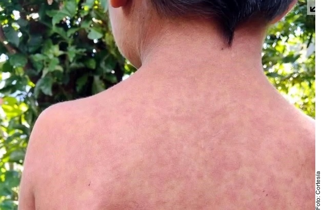 Persiste brote de sarampión en México.- OPS