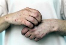 Reportan Sarampión en los 32 estados de México