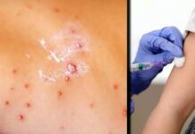 Concentra México 71% de casos de sarampión en región.- OPS