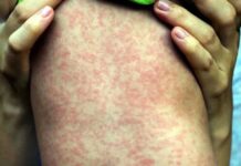 México reporta otra muerte por sarampión; suman 28