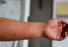 México suma 32 fallecimientos por sarampión