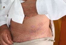 Herpes zóster: una enfermedad poco conocida