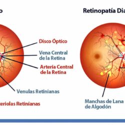 En desarrollo, gotas oftálmicas para prevenir la pérdida de visión en personas con diabetes1