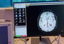 IMSS Coahuila fortalece atención de embolias cerebrales con el Código Cerebro